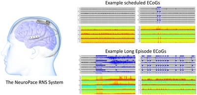 Expert and deep learning model identification of iEEG seizures and seizure onset times